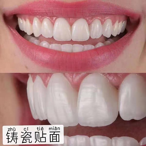 铸瓷贴面